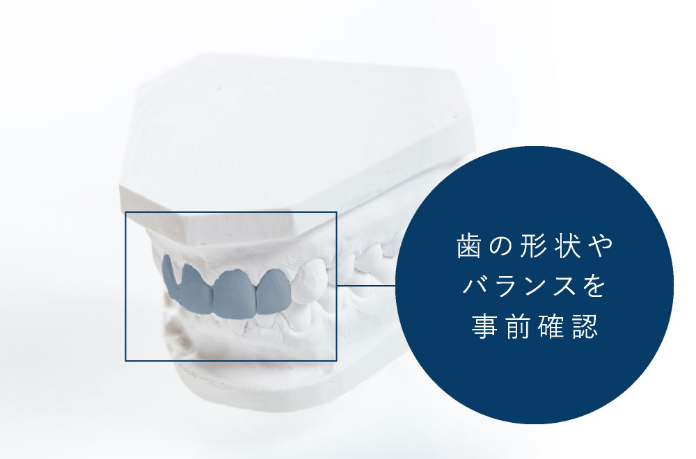 歯の形状やバランスを事前確認