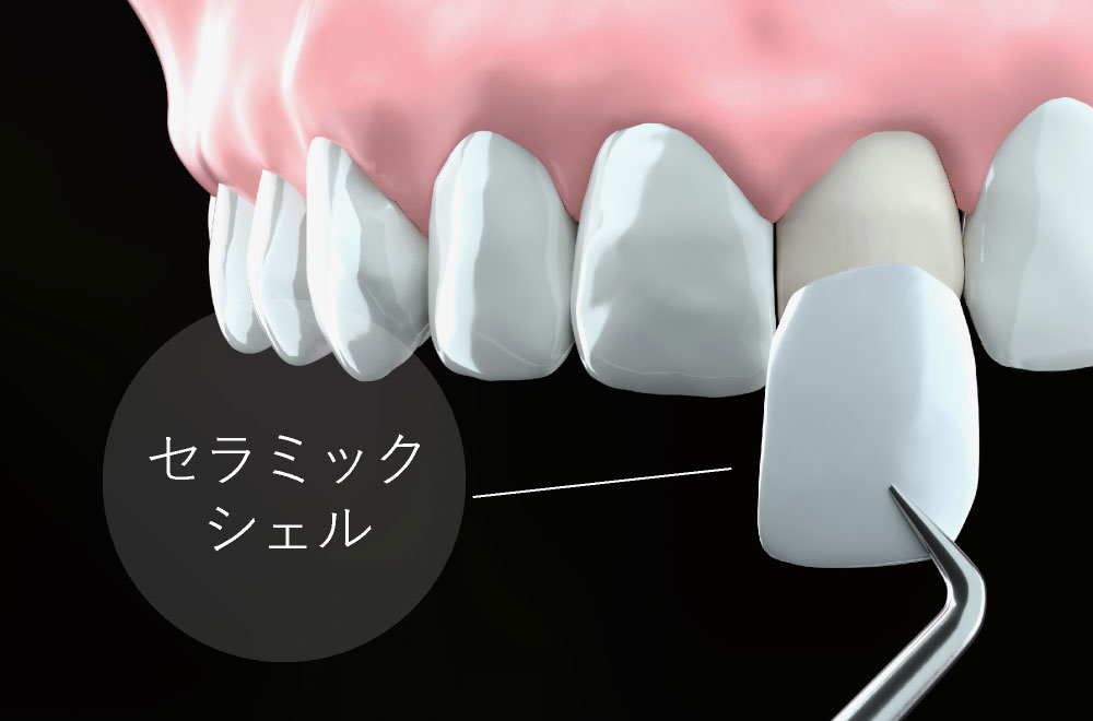 セラミックシェル