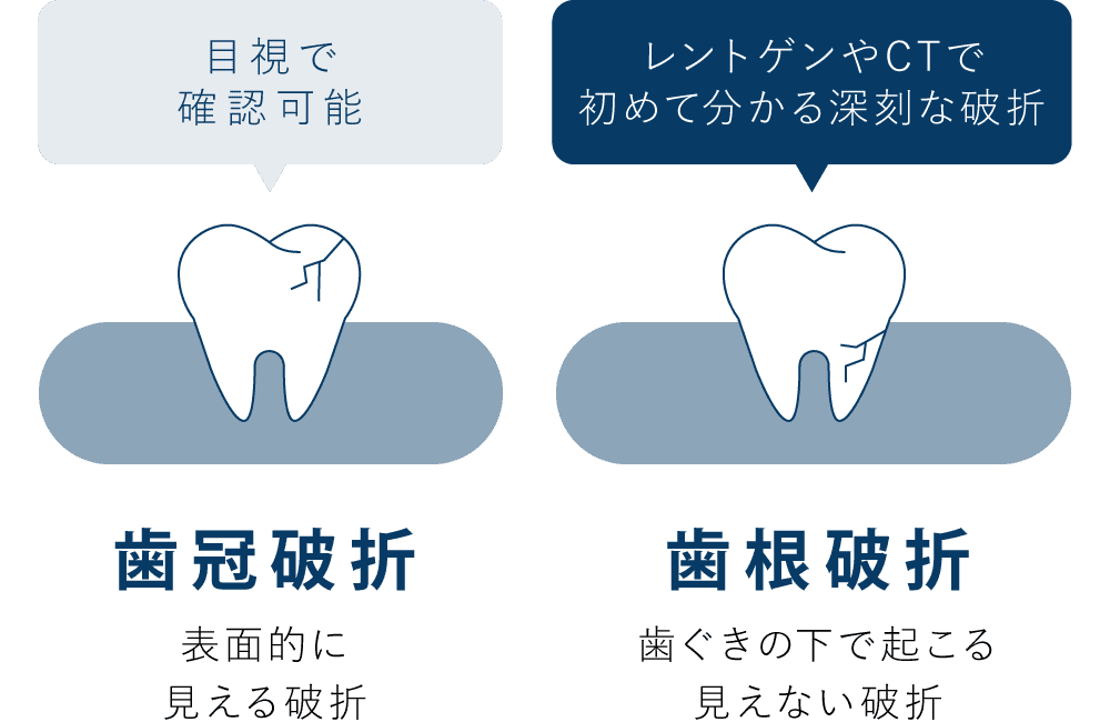「歯冠破折」表面的に見える破折・目視で確認可能　「歯根破折」歯ぐきの下で起こる見えない破折・レントゲンやCTで初めて分かる深刻な破折