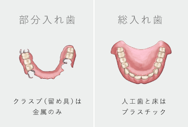 部分入れ歯：クラスプ（留め具）は金属のみ/総入れ歯：人工歯と床はプラスチック
