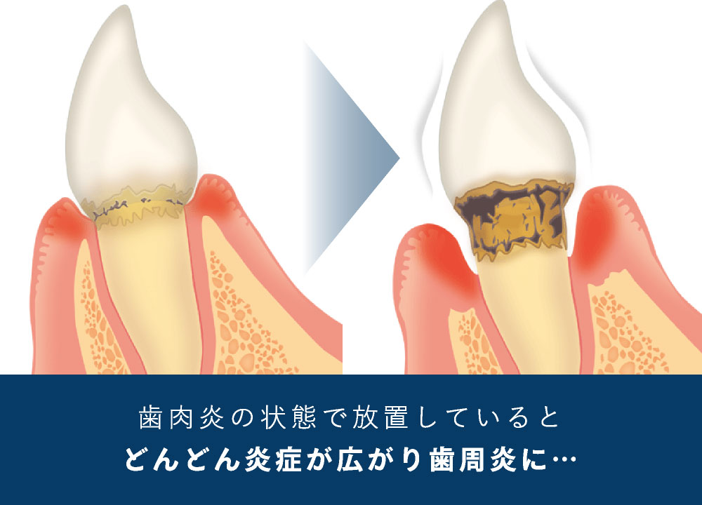 歯肉炎の状態で放置しているとどんどん炎症が広がり歯周炎に…