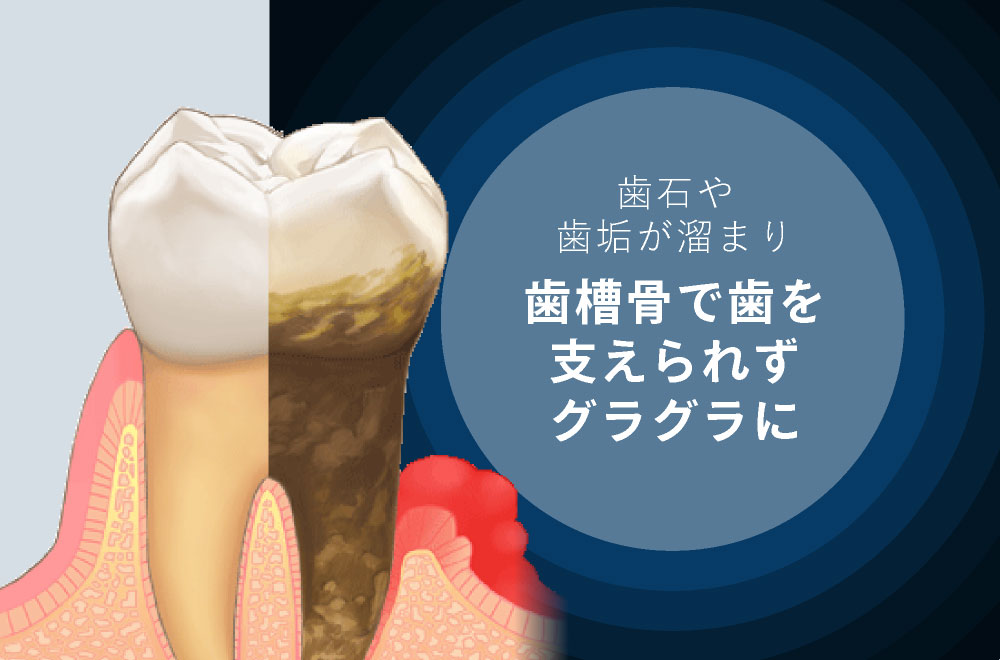 歯石や歯垢が溜まり歯槽骨で歯を支えられずグラグラに