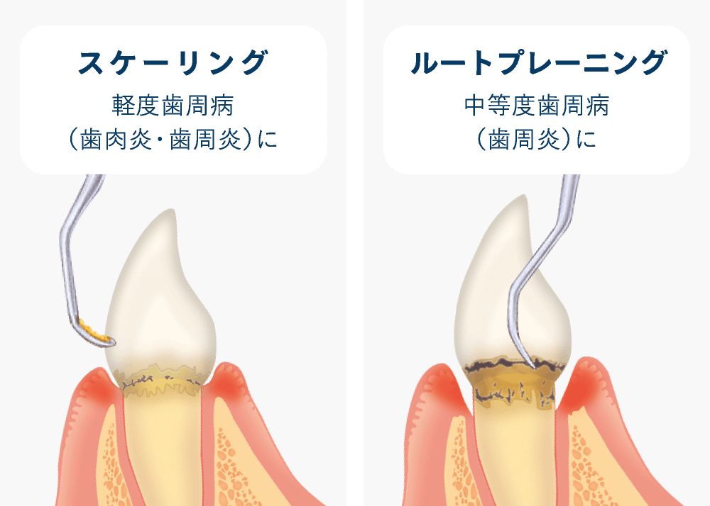 スケーリング／ルートプレーニング